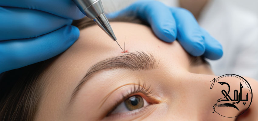 کاشت ابرو چیست؟