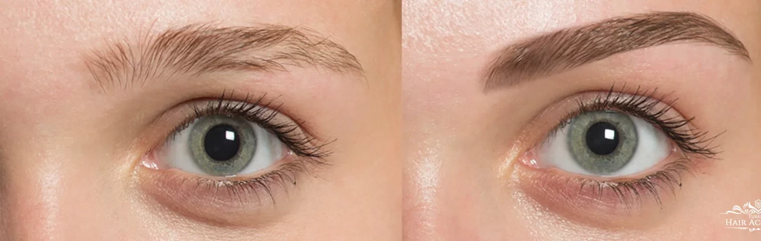 چطور از ریزش ابرو پس از کاشت ابرو جلوگیری کنیم؟